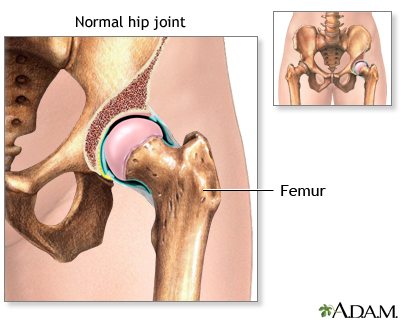 Hip joint replacement - Series