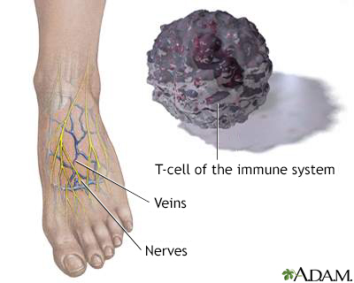 Diabetic foot care